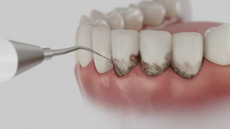 Trusted Wisdom Tooth Removal service in Keedysville, MD - Dentist Open Now